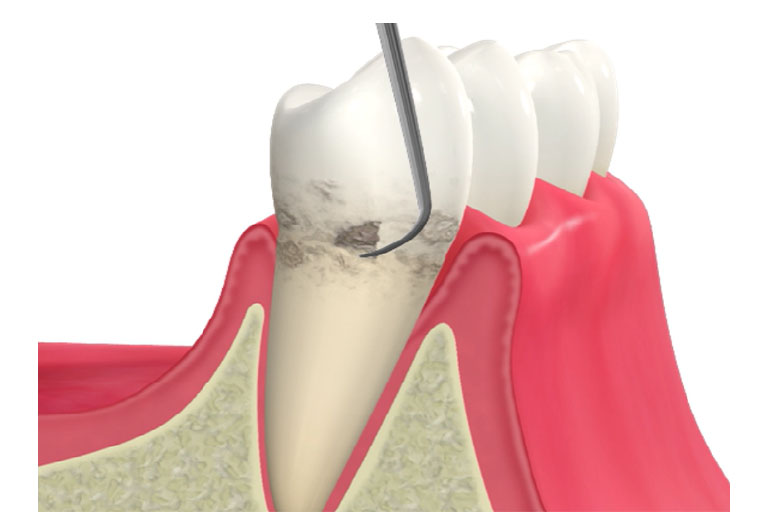 歯周初期治療（口腔衛生の改善、歯石除去）